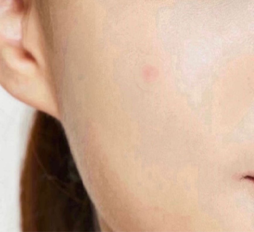 Cosrx Acne Pimple Master Patch - Görsel 5