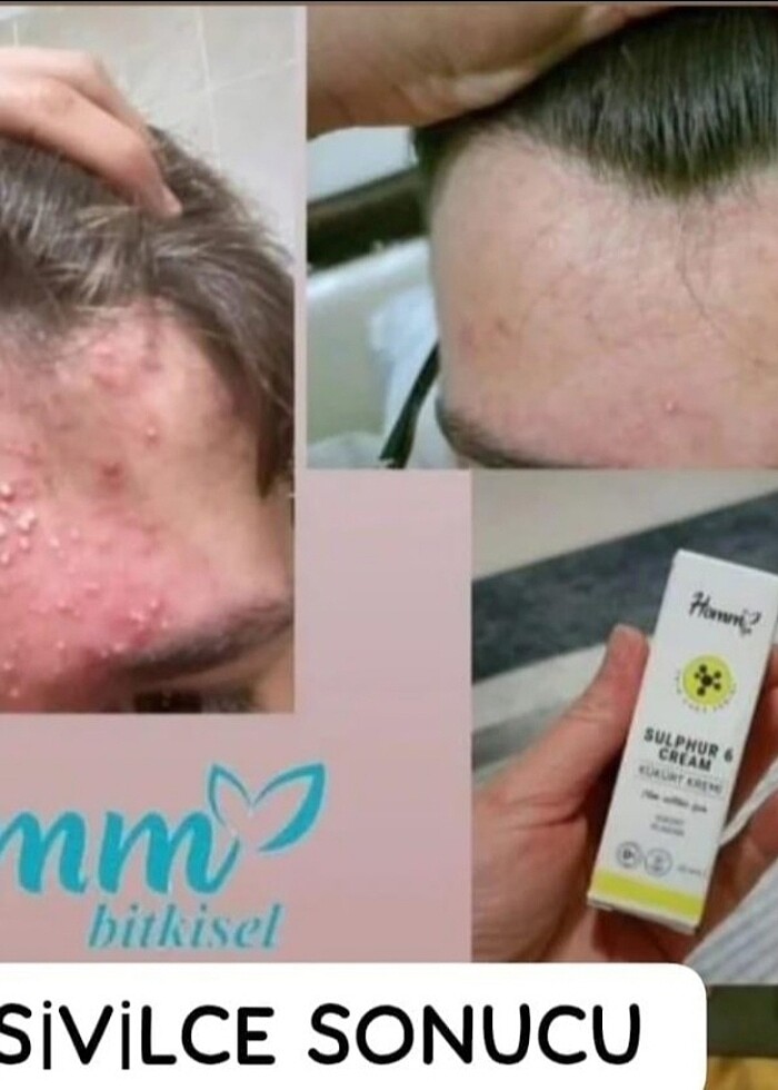 Kükürt kremi sivilceli ciltlere homm bitkisel - Görsel 2