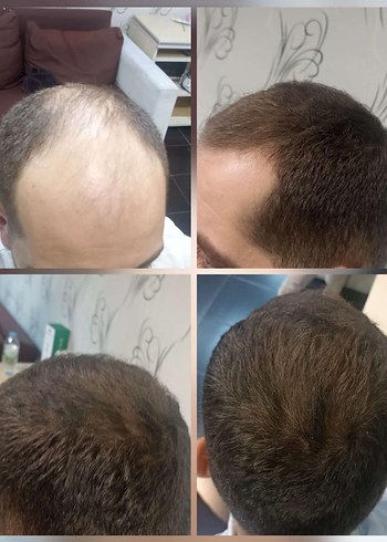 P S Hair Solüsyon Saç Serumu %100 saç çıkartır - Görsel 4