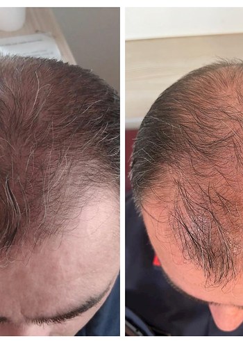 P S Hair Solüsyon Saç Serumu %100 saç çıkartır - Görsel 5