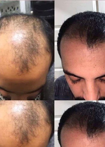 P S Hair Solüsyon Saç Serumu %100 saç çıkartır - Görsel 3