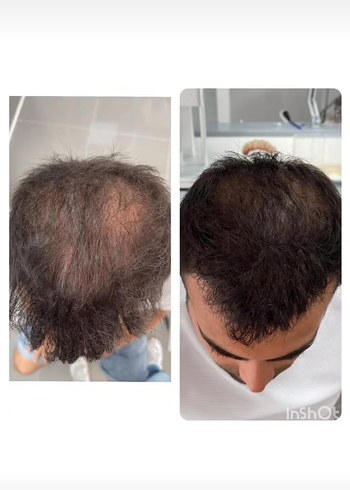 P S Hair Solüsyon Saç Serumu %100 saç çıkartır - Görsel 7
