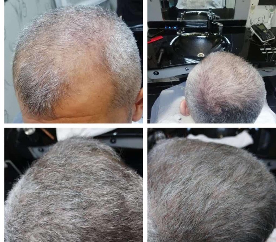 P S Hair Solüsyon Saç Serumu %100 saç çıkartır - Görsel 2