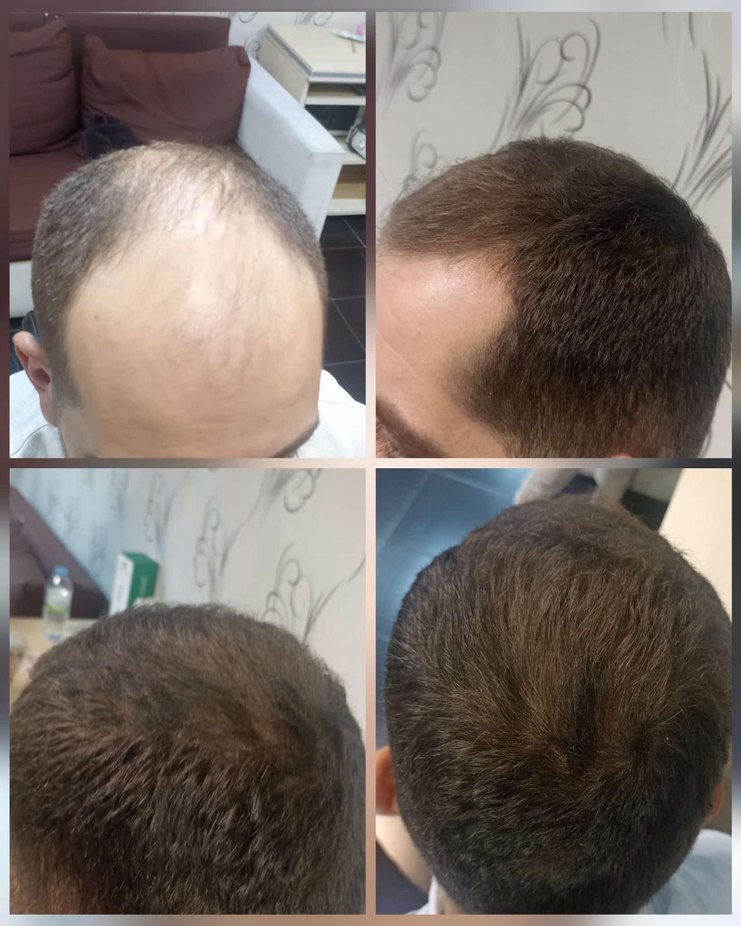 P S Hair Solüsyon Saç Serumu %100 saç çıkartır - Görsel 4