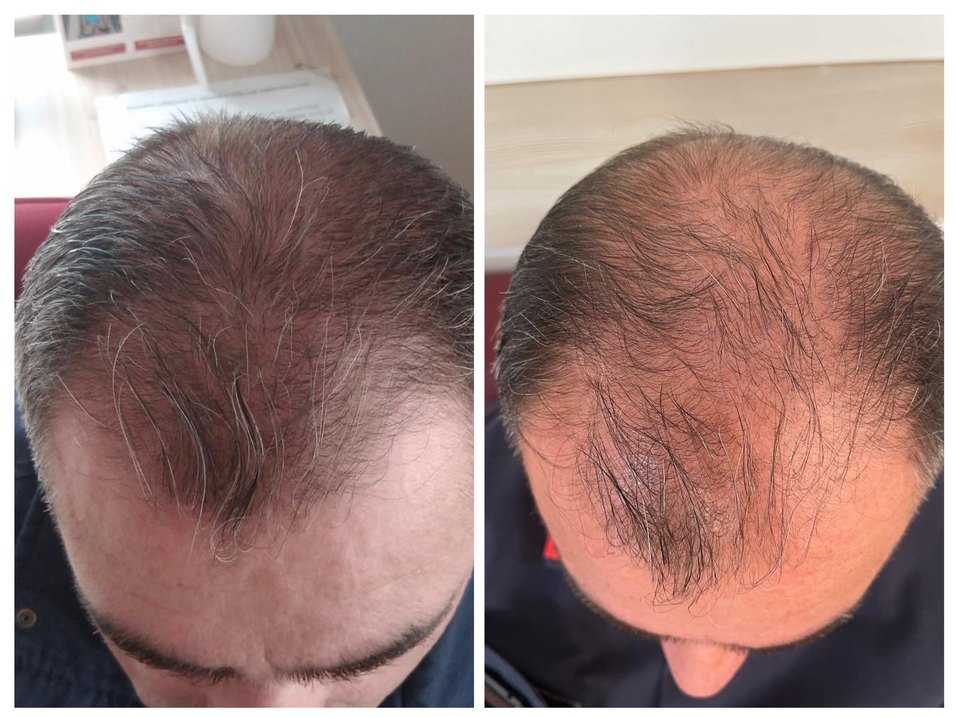 P S Hair Solüsyon Saç Serumu %100 saç çıkartır - Görsel 5