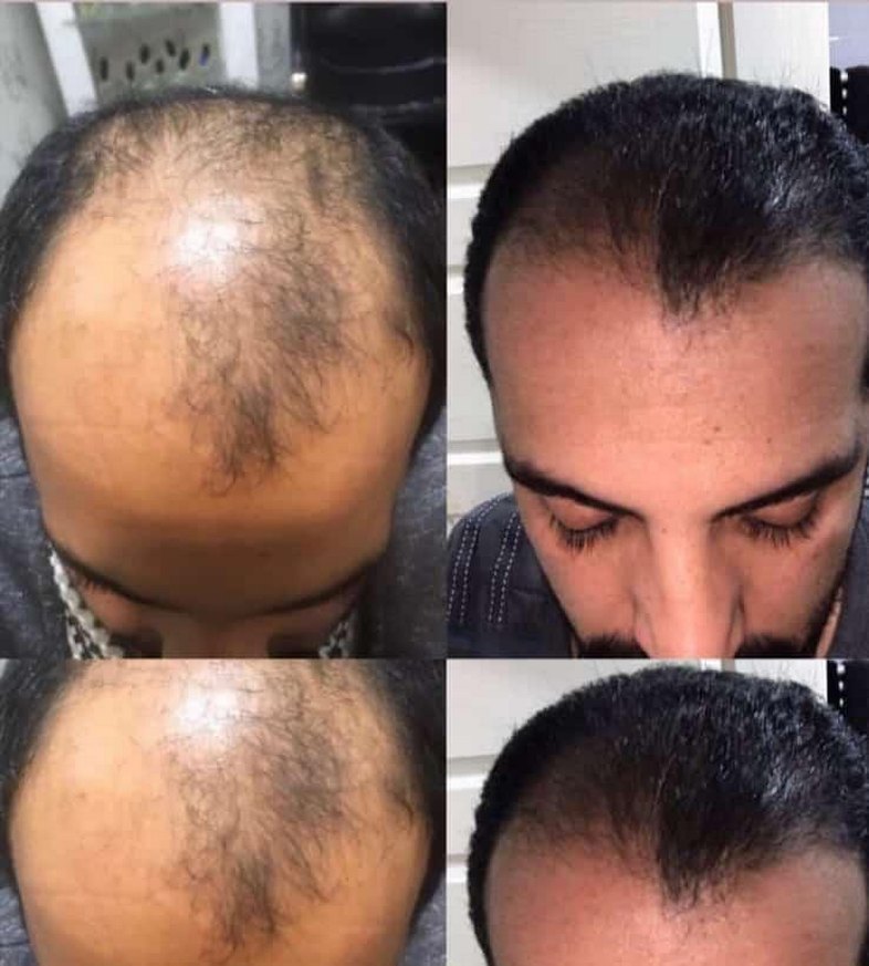 P S Hair Solüsyon Saç Serumu %100 saç çıkartır - Görsel 3