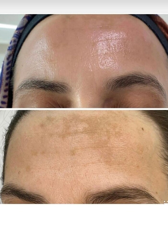 Derma delete soyucu krem - Görsel 2