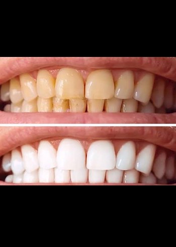 Diş Beyazlatma Süngeri - Görsel 2