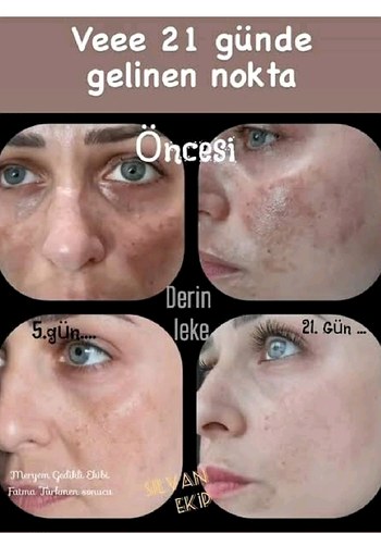 Homm Bitkisel Cilt Lekesi Çözümü - Görsel 3