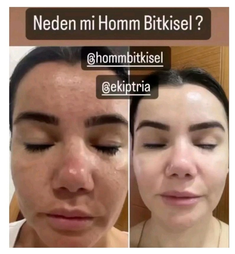 Homm Bitkisel Cilt Lekesi Çözümü - Görsel 2