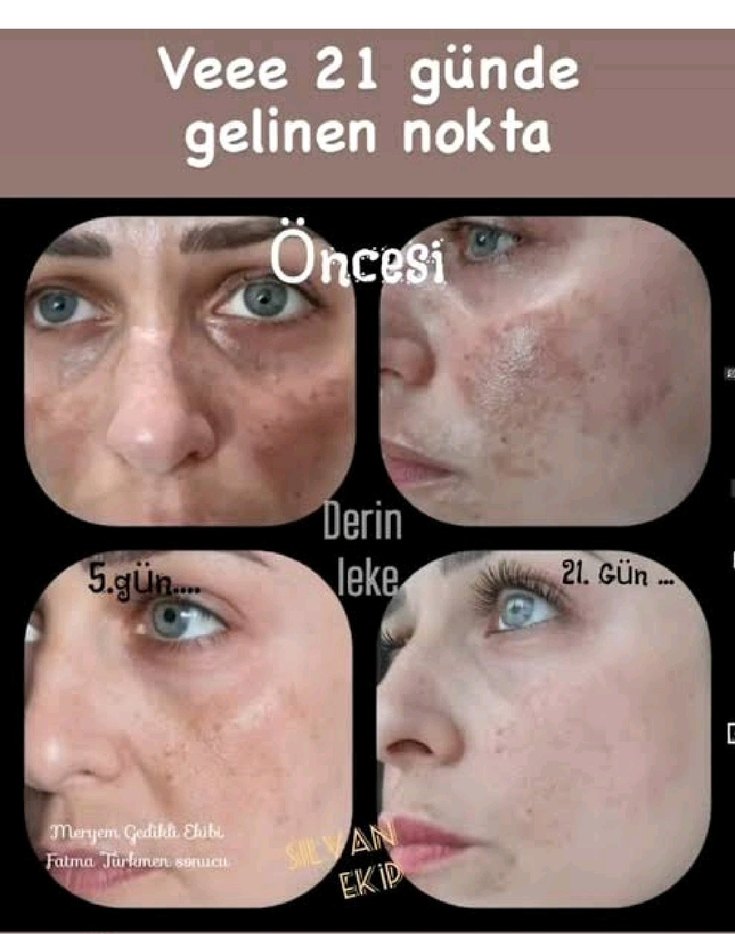 Homm Bitkisel Cilt Lekesi Çözümü - Görsel 3