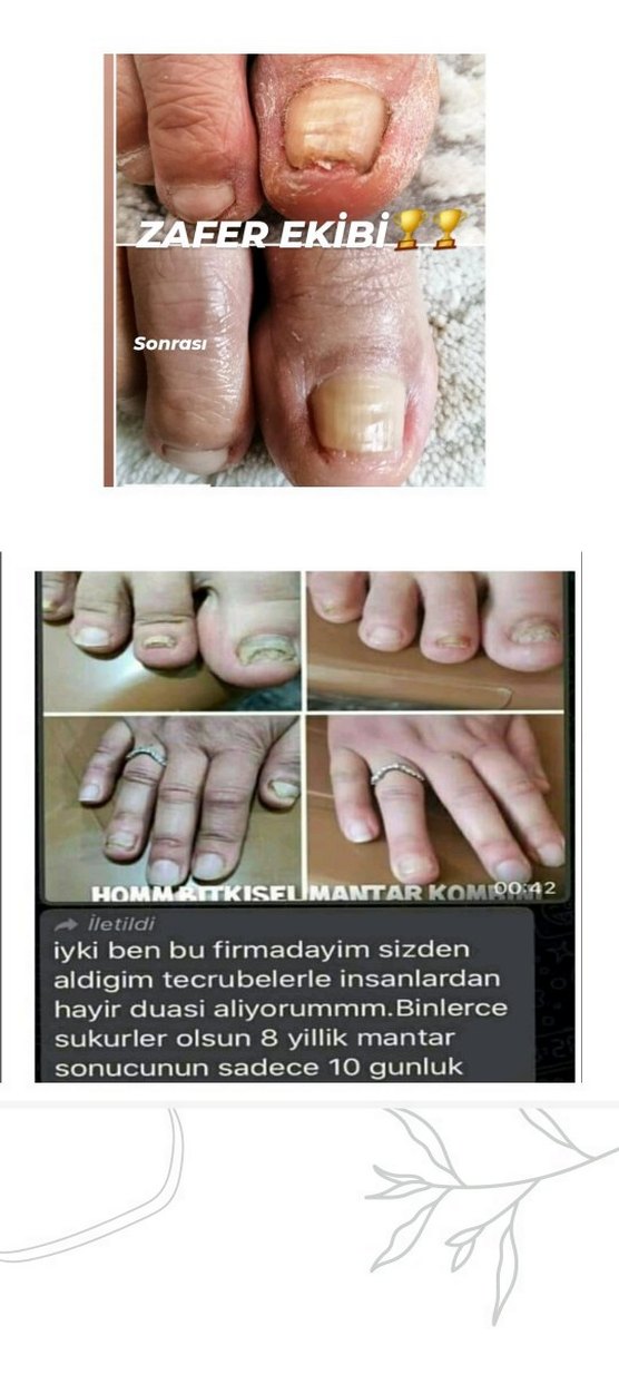 Ayak ve Tırnak Mantarı Kombin Ürünü - Görsel 2