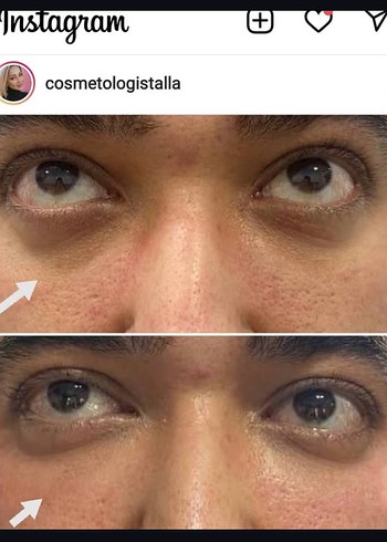 Cilt bakım/ özellikle göz çevresi - Görsel 11