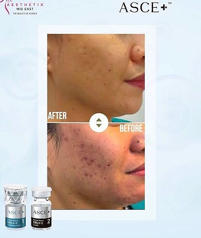 (2 seans )Asce +srlv (2 seans) sınırlı stok - Görsel 2