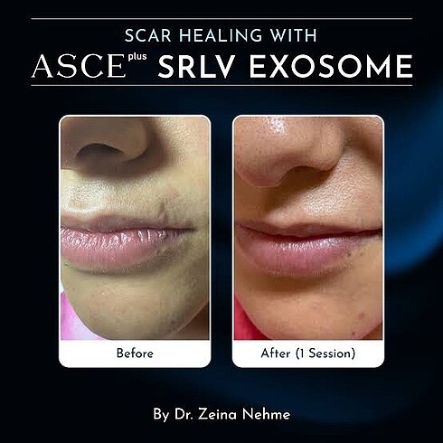 (2 seans )Asce +srlv (2 seans) sınırlı stok - Görsel 5