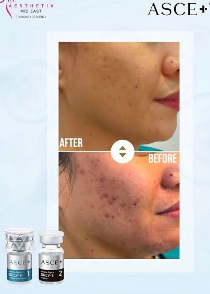 (2 seans )Asce +srlv (2 seans) sınırlı stok - Görsel 2