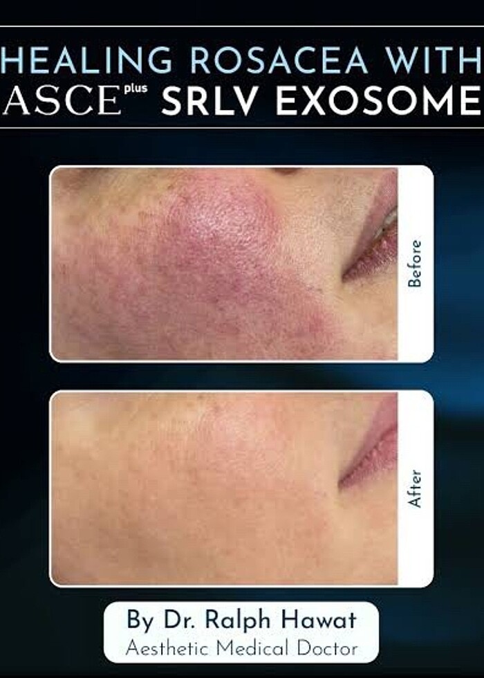 (2 seans )Asce +srlv (2 seans) sınırlı stok - Görsel 3