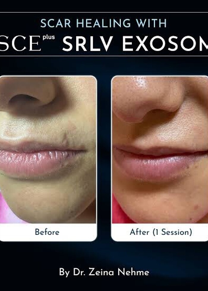 (2 seans )Asce +srlv (2 seans) sınırlı stok - Görsel 5