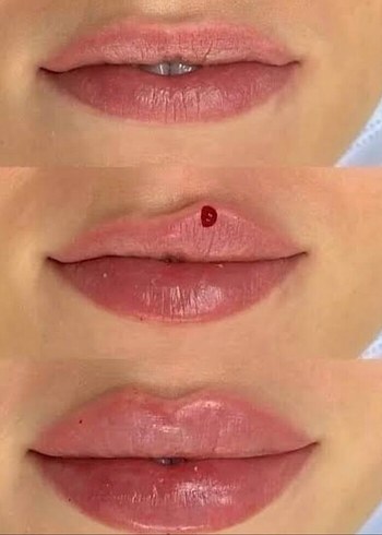 Dudak dolgusu orta yüz dolgusu - Görsel 2