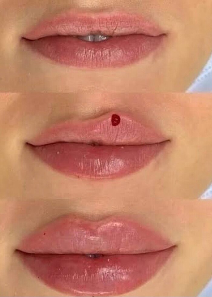 Dudak dolgusu orta yüz dolgusu - Görsel 2