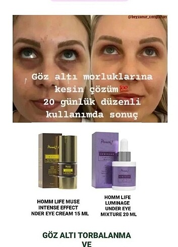 Goz altı morlukları 