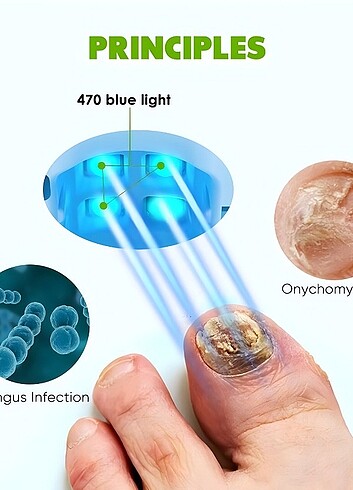 Tırnak mantar tedavisi lazer cihazı - Görsel 8