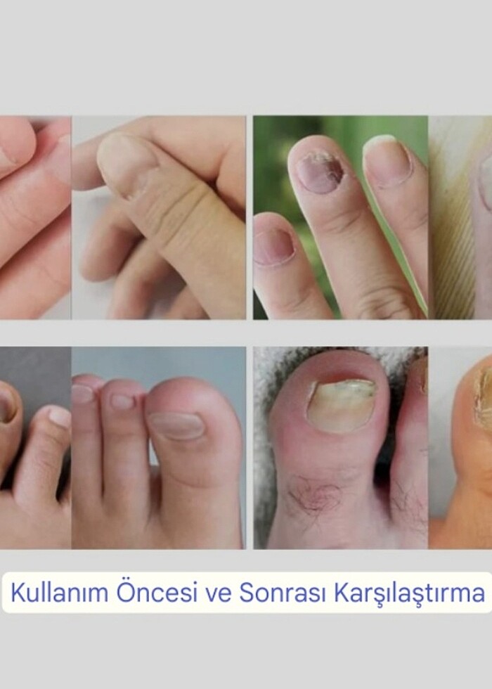 Tırnak mantar tedavisi lazer cihazı - Görsel 2