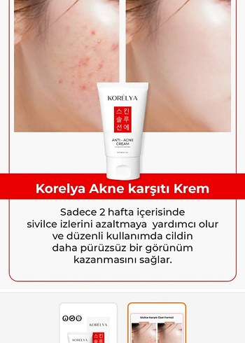 Korelya Anti-Akne Kremi - Görsel 2
